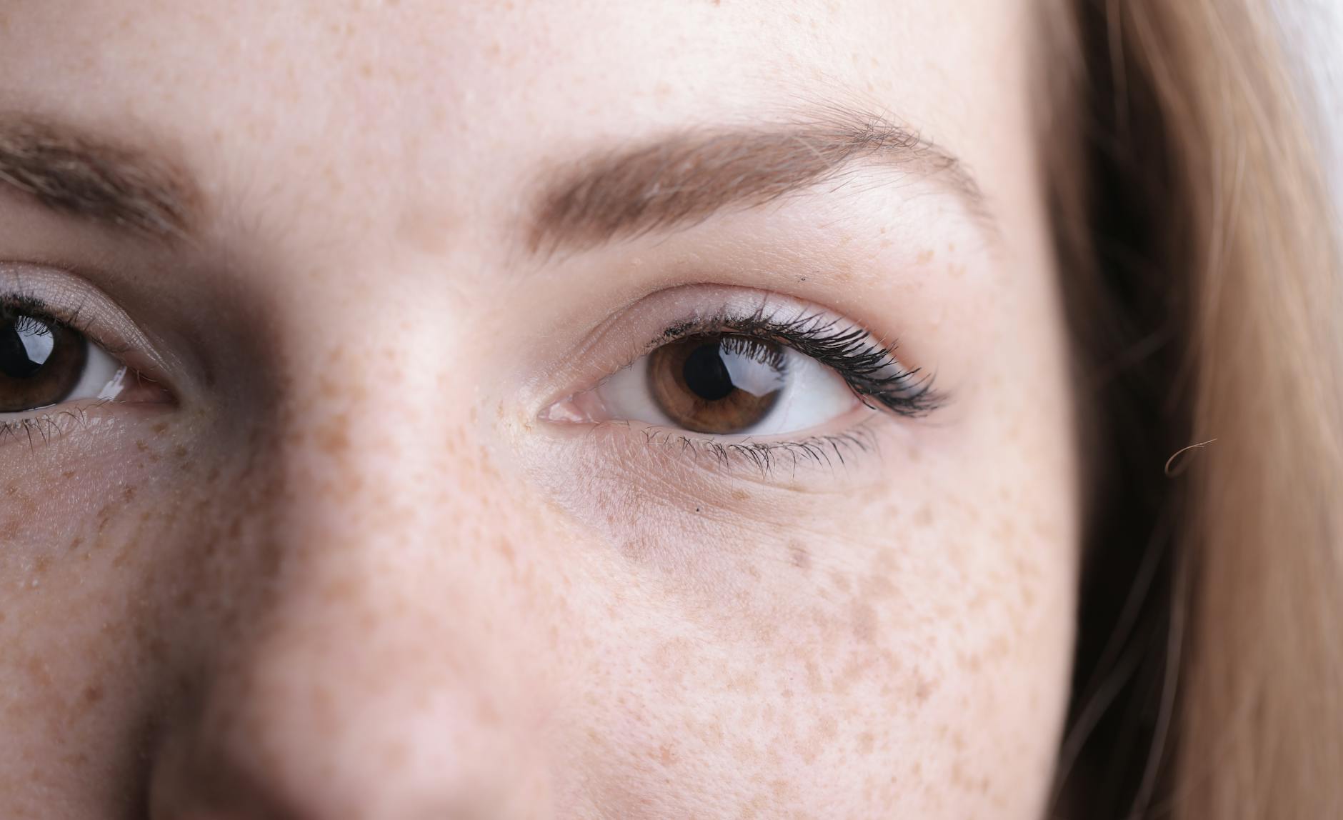 Why VISIA Complexion Analysis Is Used Before Acne Treatment - Featured image