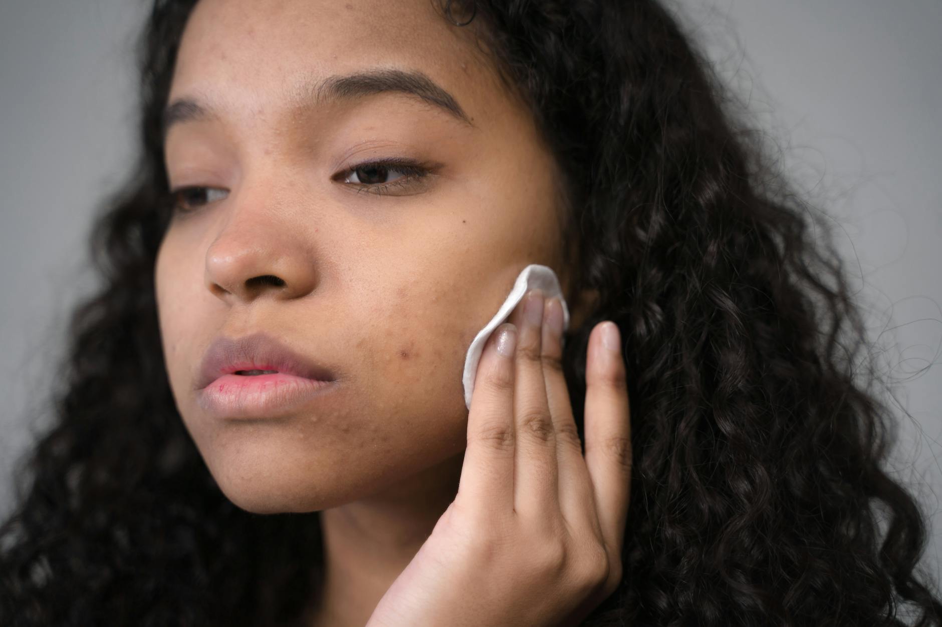 Why You're Getting Acne on Your Temples - Featured image