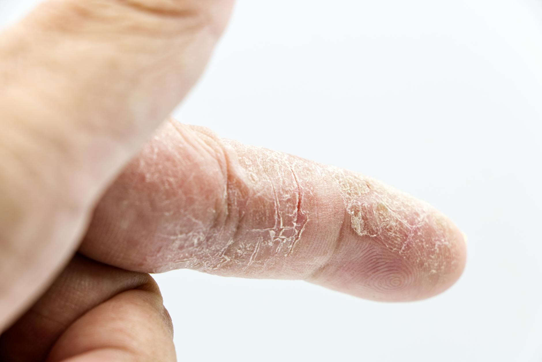 Acne Is the Most Common Skin Condition Americans Face