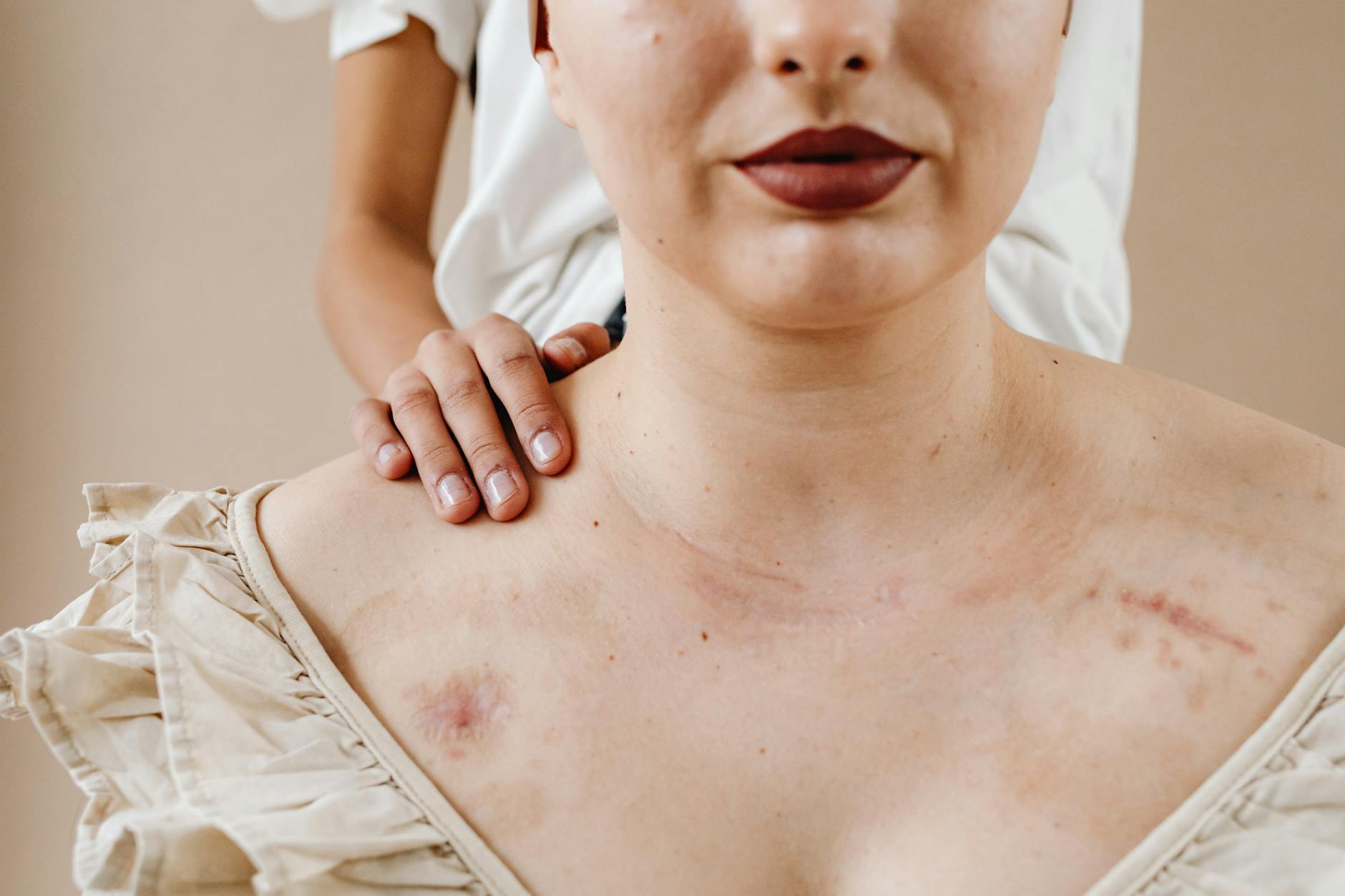 How Does Back Acne Scarring Differ From Facial Acne Scars, and Does This Affect Treatment Options?