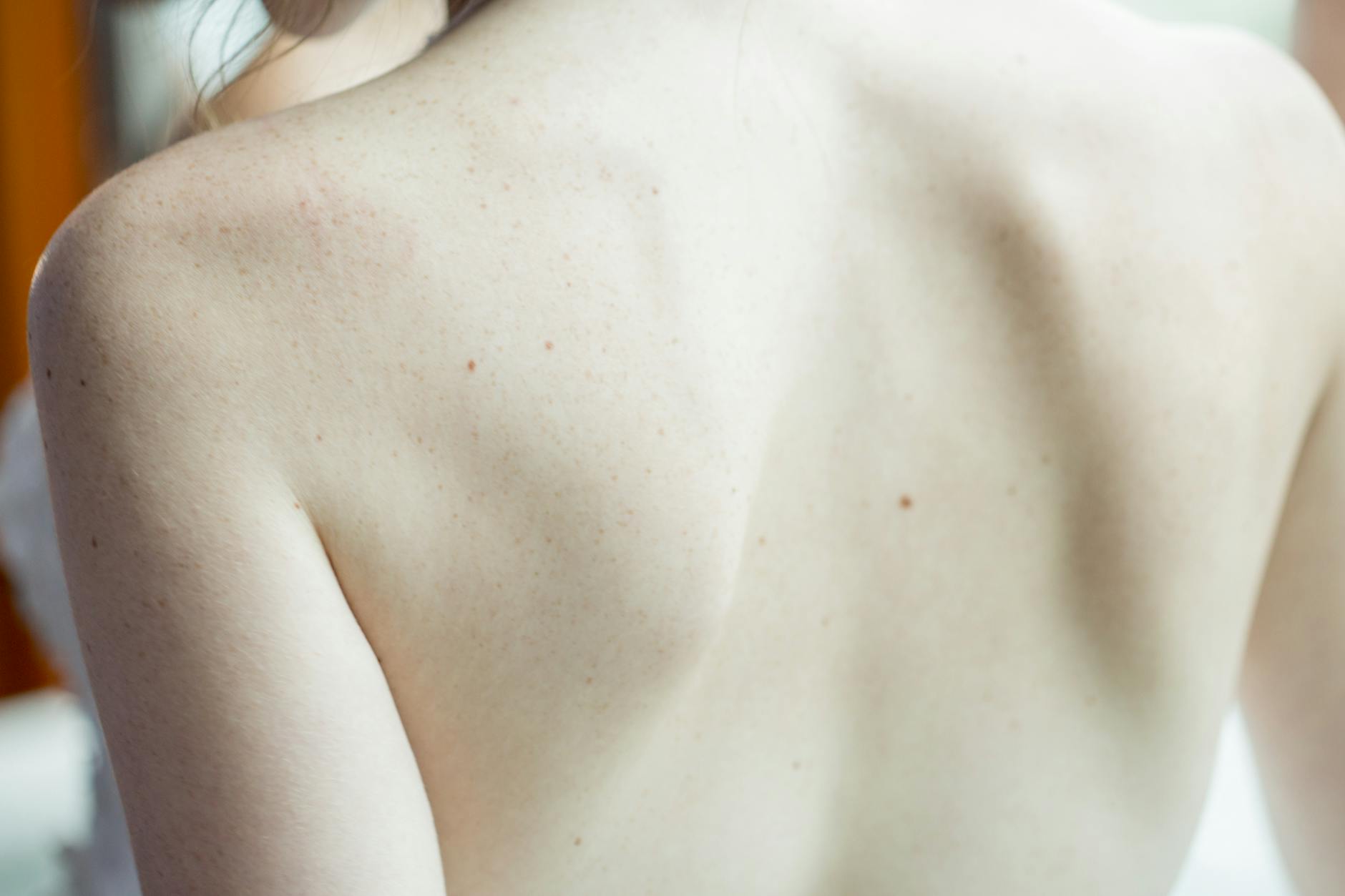 Why Men With Back Acne Remain Uninformed About Sunscreen Chemistry