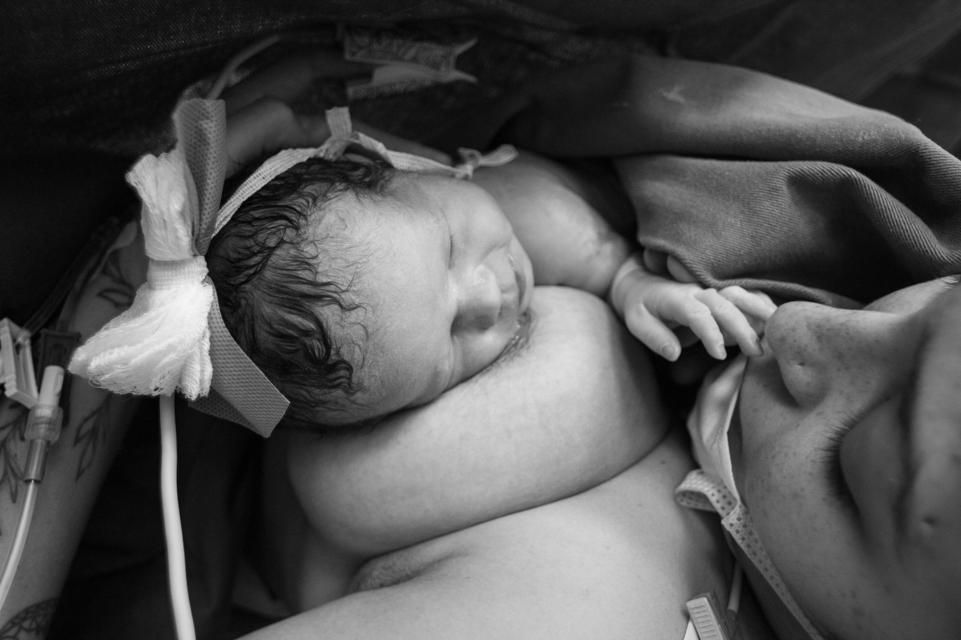 At Least 35% of New Mothers With Postpartum Acne Report That Pore Size Is Genetically Determined and Cannot Be Permanently Shrunk - Featured image