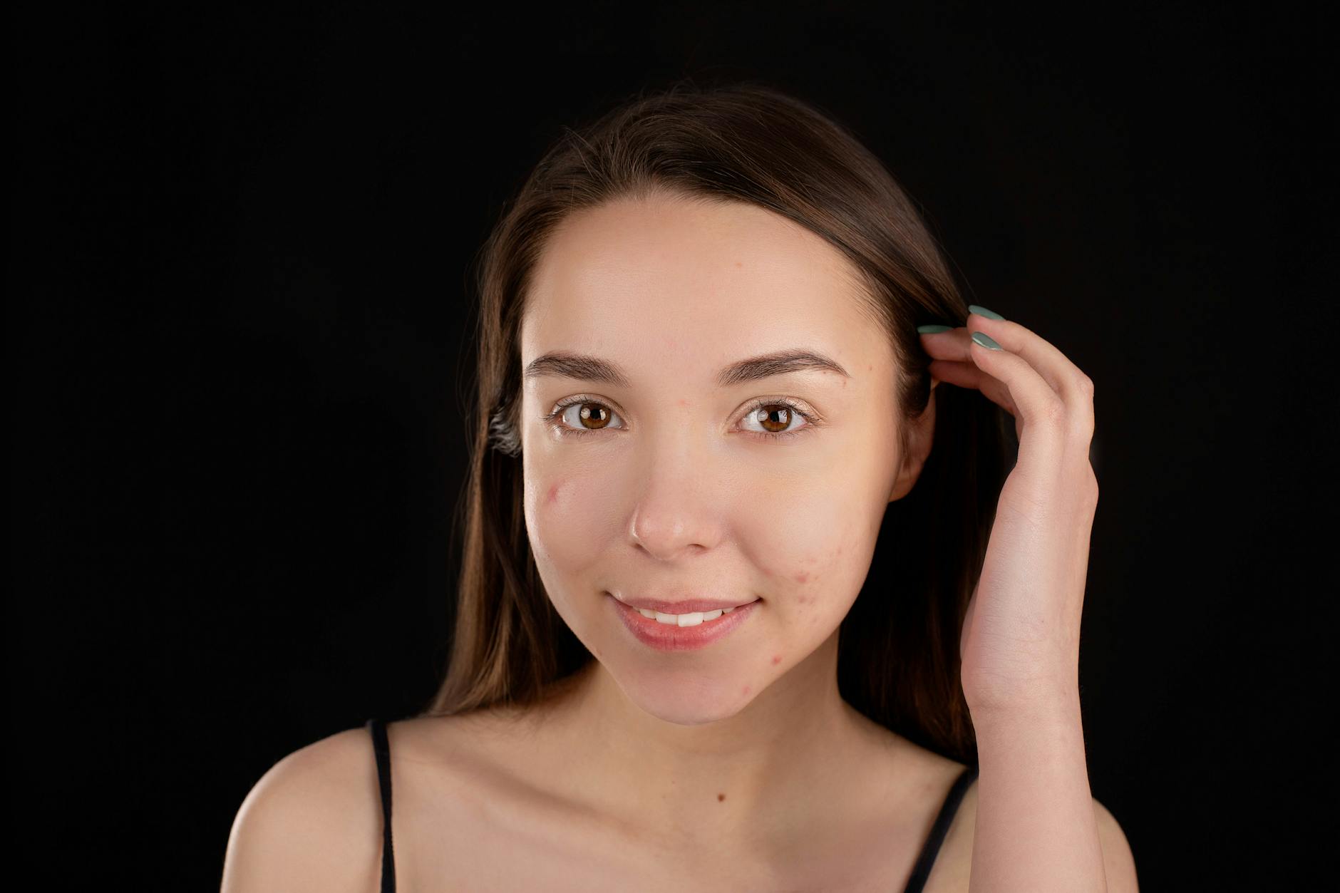 At Least 43% of People With Acne Scars Have Experienced Acne Around the Mouth May Actually Be Perioral Dermatitis - Featured image