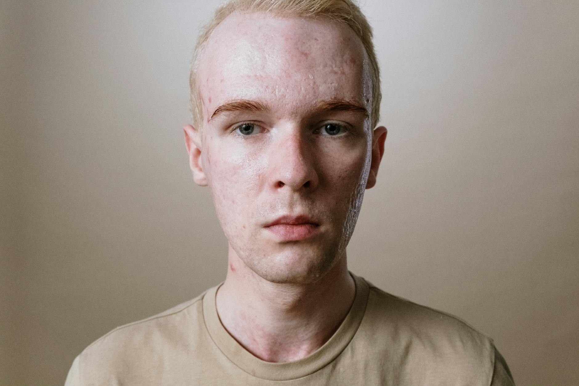 At Least 43% of Teenagers With Acne Have Tried Pore Size Is Genetically Determined and Cannot Be Permanently Shrunk - Featured image