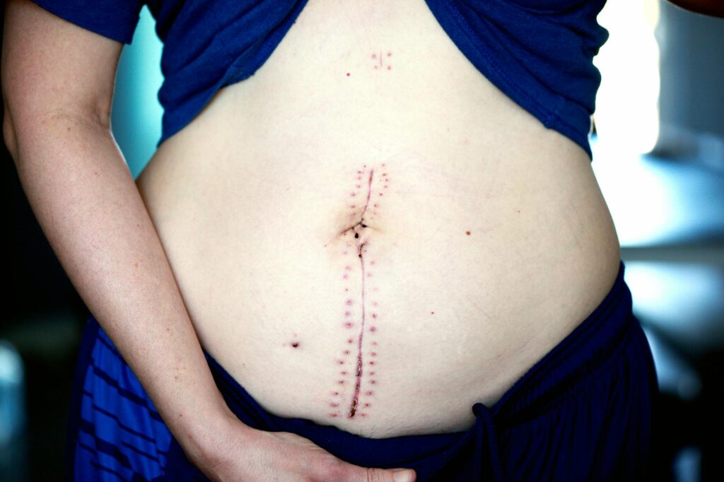 At Least 46% of Patients Seeking Scar Treatment Have Tried Picking at Acne Can Push Bacteria Deeper and Cause Permanent Scarring - Featured image