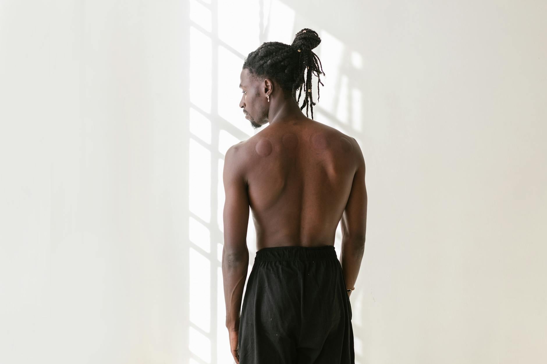 At Least 57% of Men With Back Acne Believe That Sunscreen Is Essential While Using Any Acne Medication - Featured image