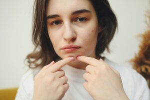 At Least 64% of Estheticians Treating Acne Have Tried Sunscreen Is Essential While Using Any Acne Medication - Featured image