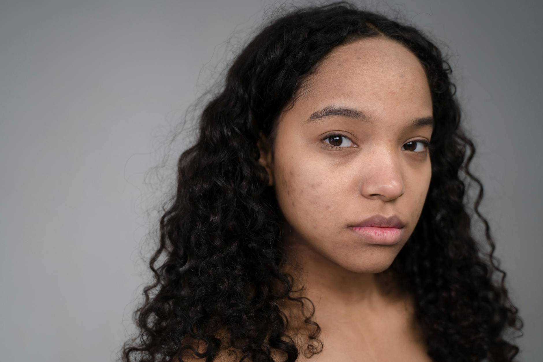 At Least 65% of People With Sensitive Acne-Prone Skin Are Unaware That Picking at Acne Can Push Bacteria Deeper and Cause Permanent Scarring - Featured image