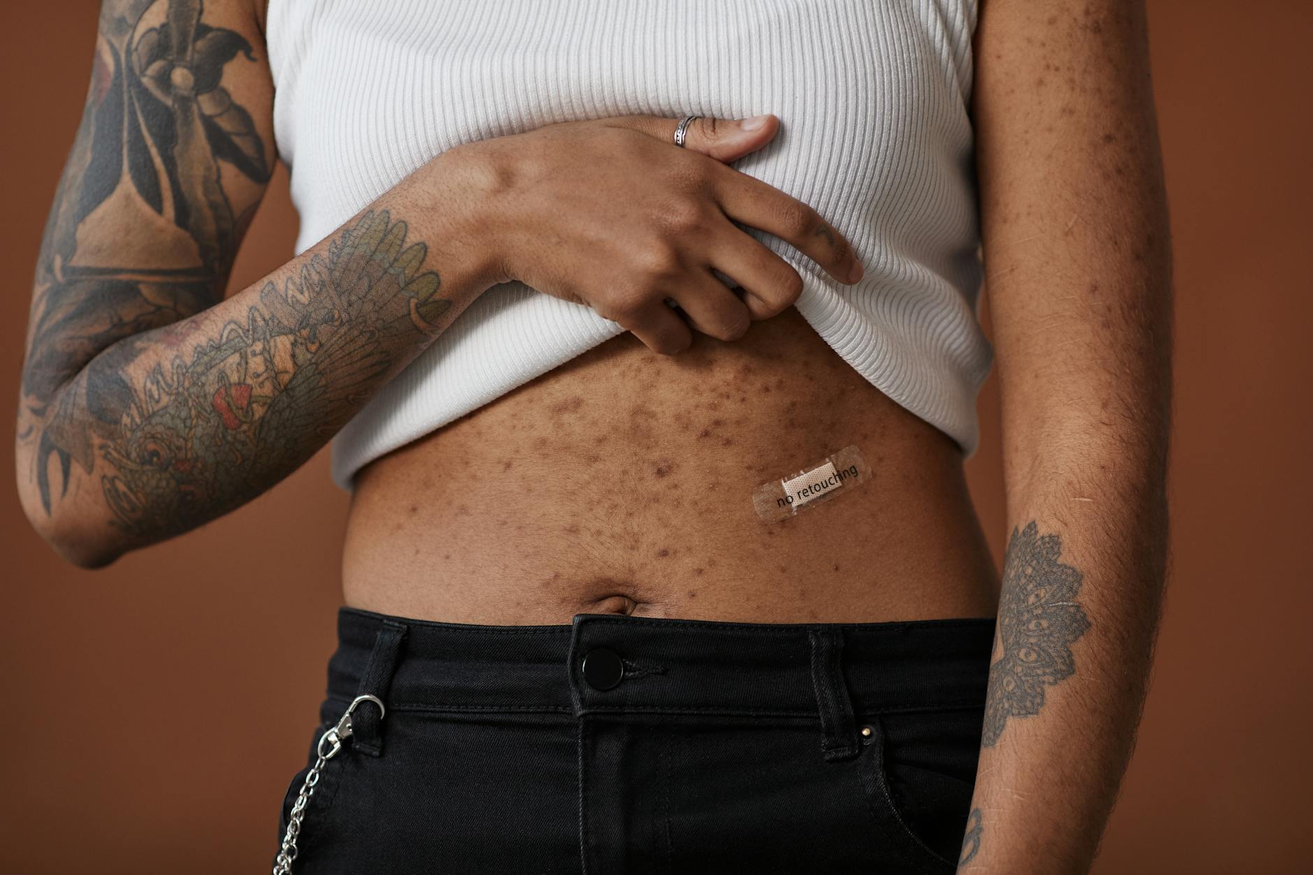 At Least 78% of Patients With Body Acne Report That Sunscreen Is Essential While Using Any Acne Medication - Featured image