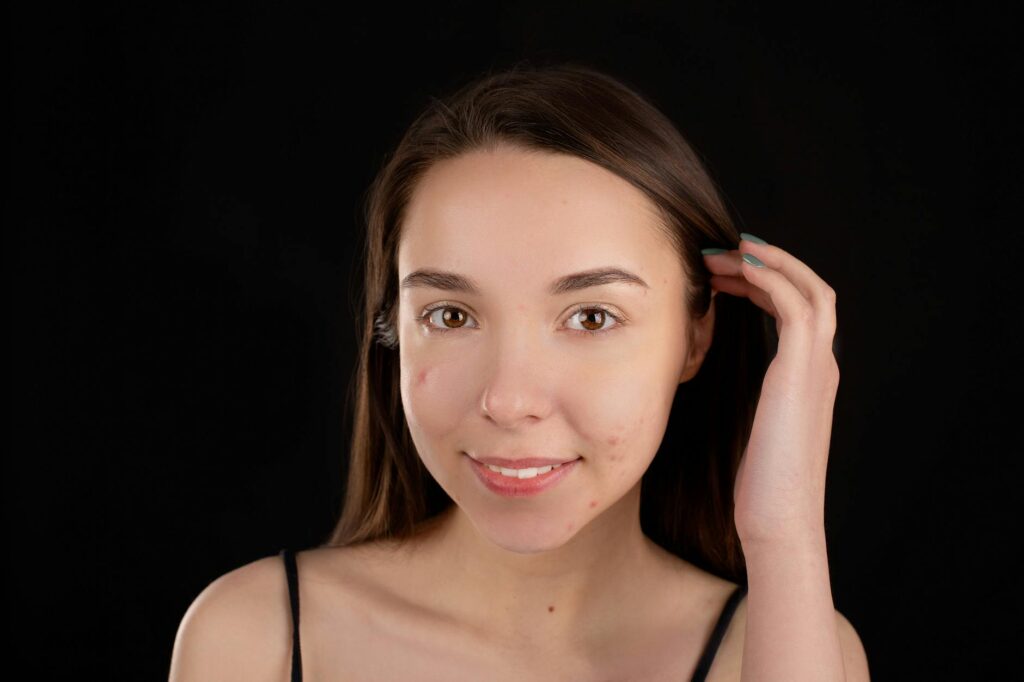 At Least 79% of Parents of Teens With Acne Have Never Been Told That Benzoyl Peroxide at 2.5% Is Just as Effective as 10% - Featured image