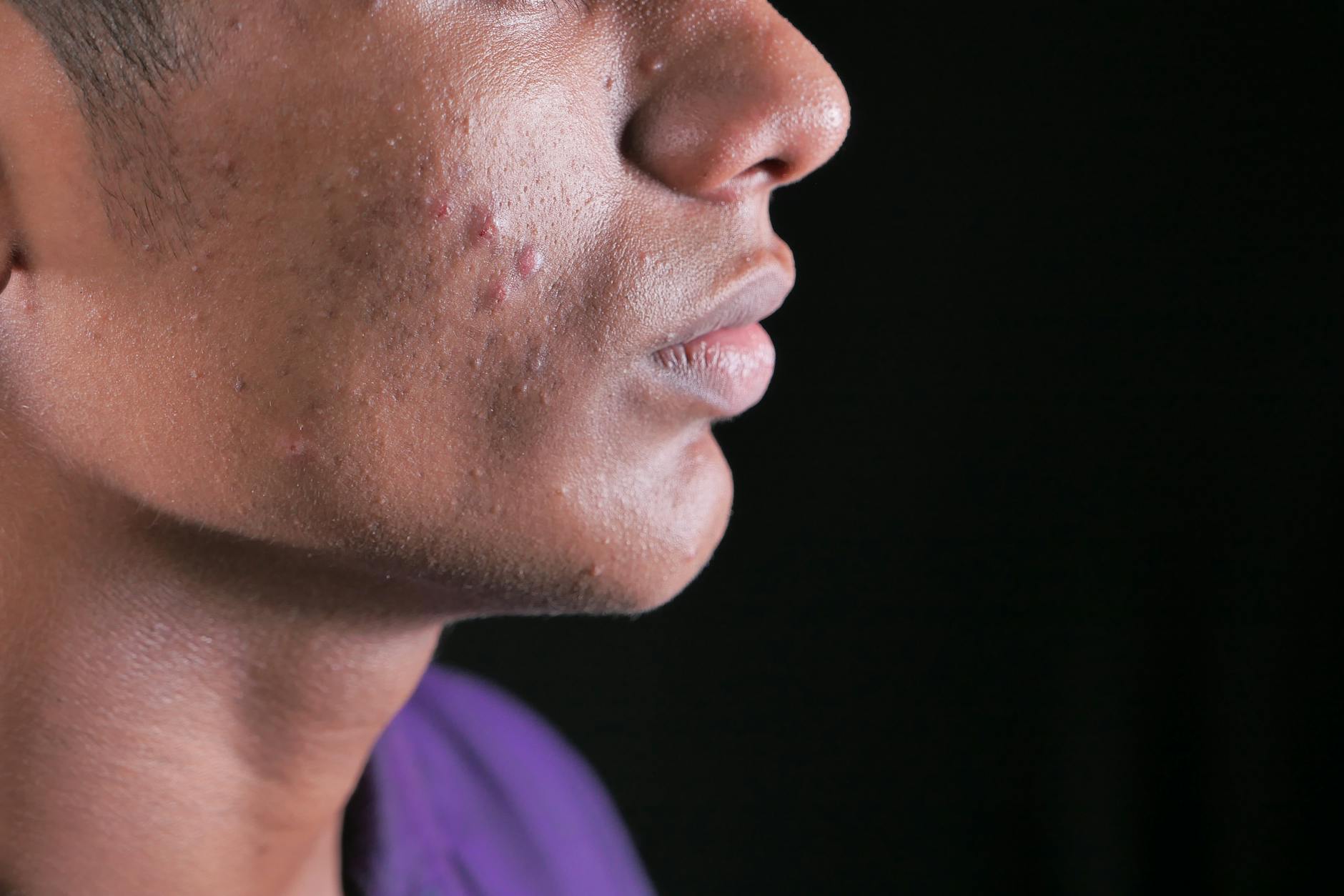 At Least 83% of Adults With Persistent Acne Say That Post-Inflammatory Hyperpigmentation Is Different From Permanent Scarring - Featured image