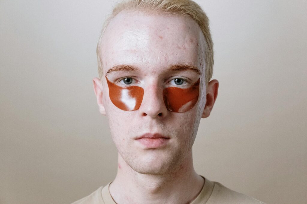 At Least 83% of Men With Back Acne Report That Stress Directly Increases Sebum Production Through Cortisol - Featured image