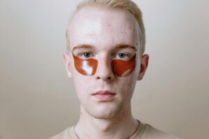 At Least 83% of Men With Back Acne Report That Stress Directly Increases Sebum Production Through Cortisol - Featured image