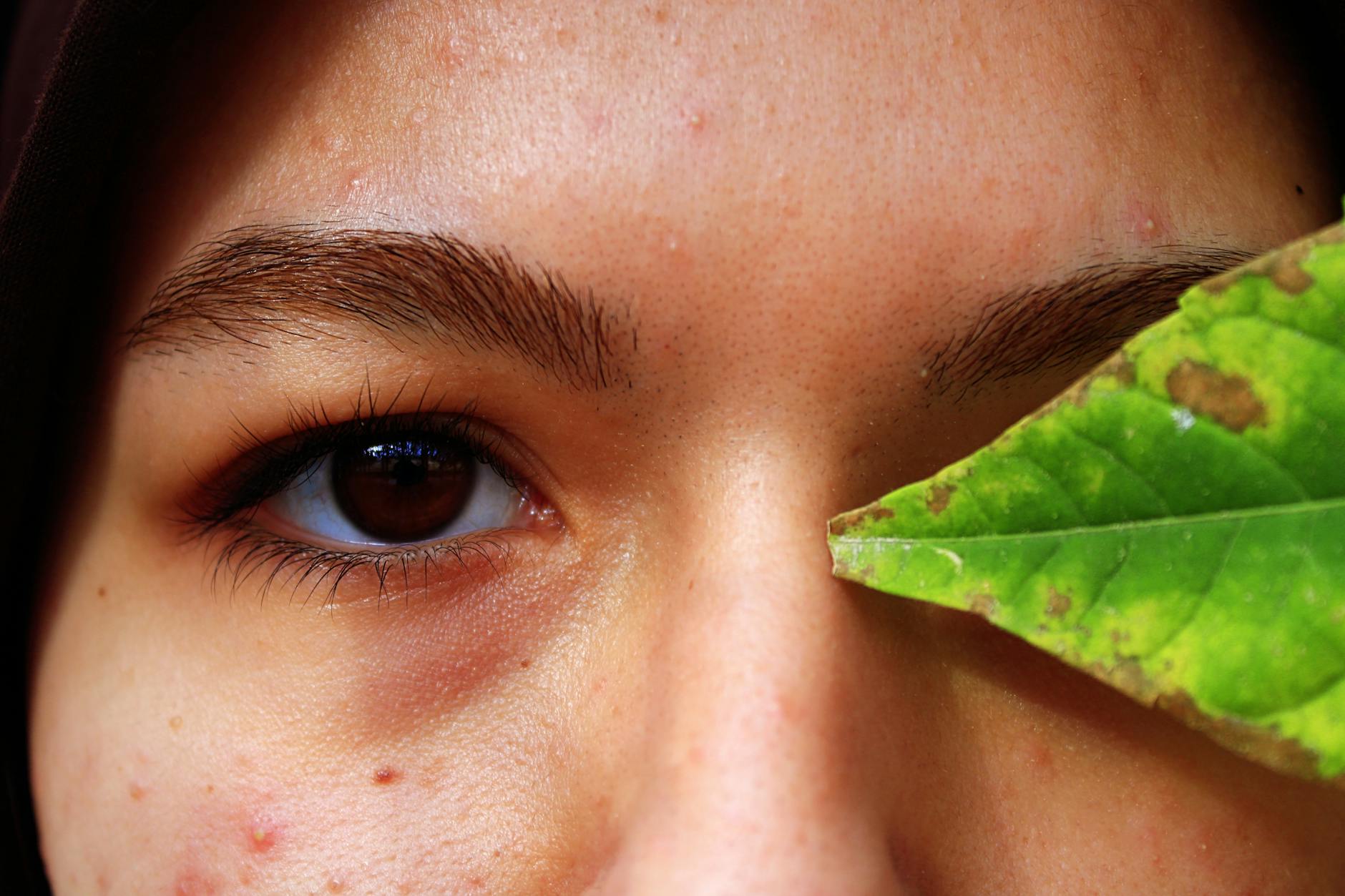 Pillowcases as a Hotspot for Acne Irritation and Bacterial Growth