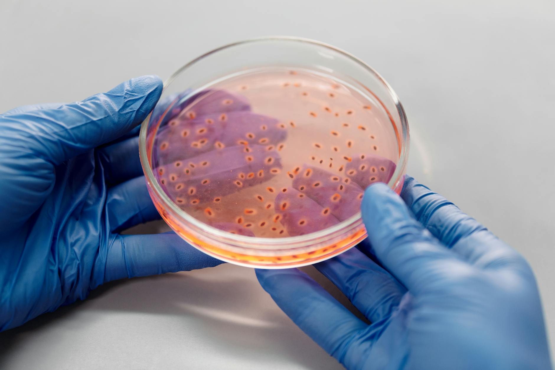 The Phone-to-Face Pipeline: How Bacteria Actually Affects Acne and Scarring