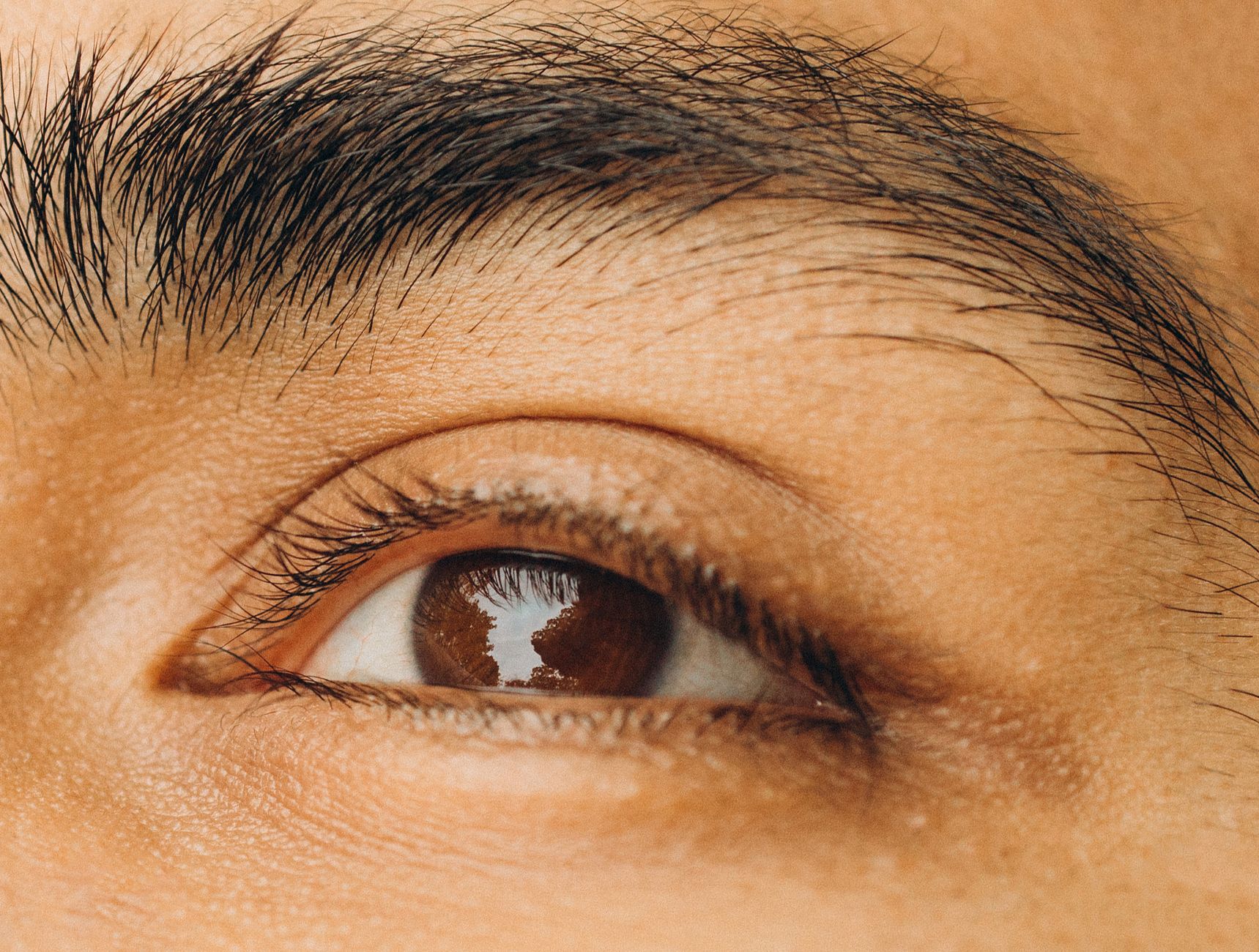 Why Are Hair Products Causing Forehead and Temple Acne in Adults?