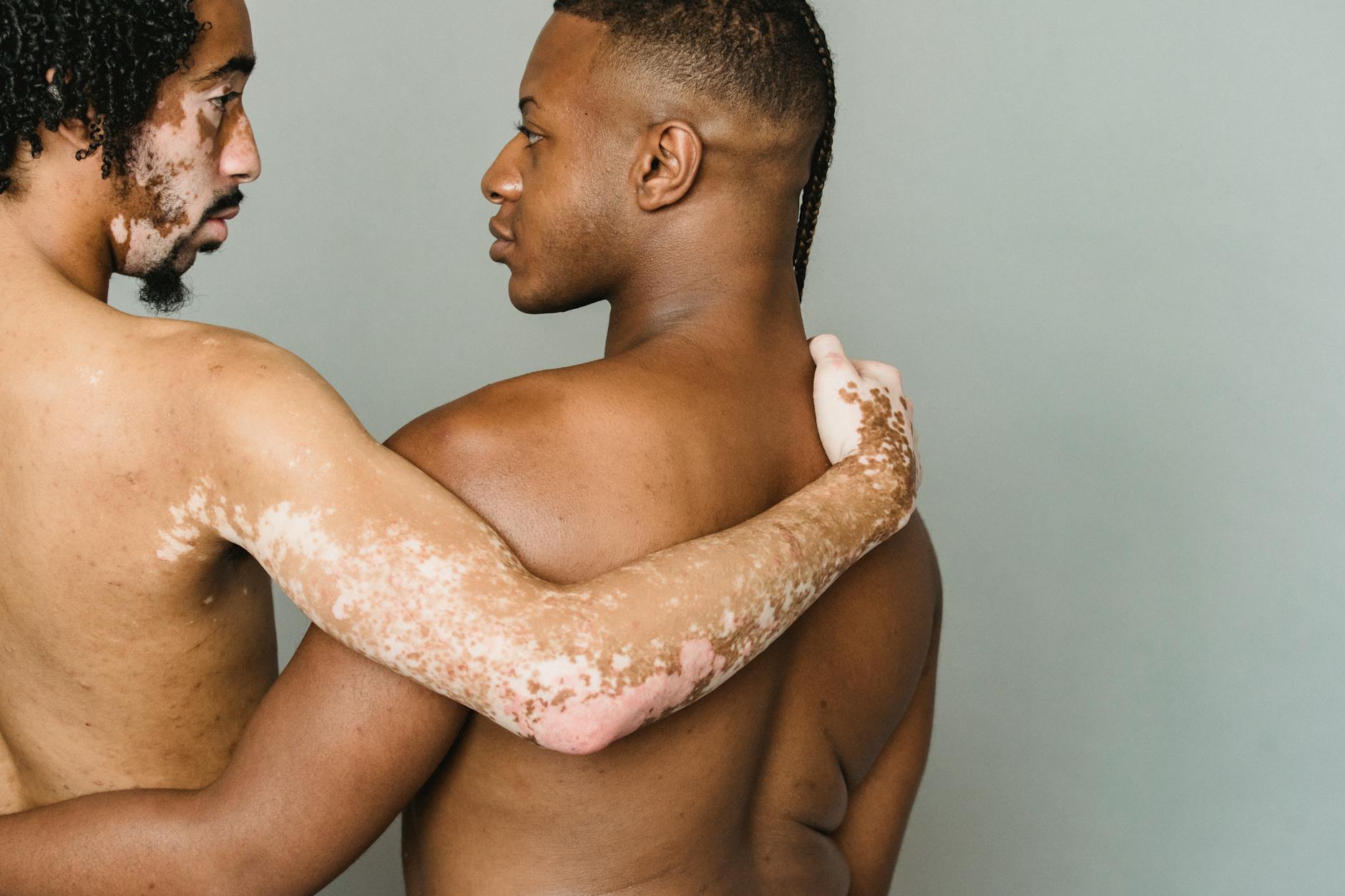 Why Do Men With Back Acne Need Sunscreen While Using Acne Treatments?