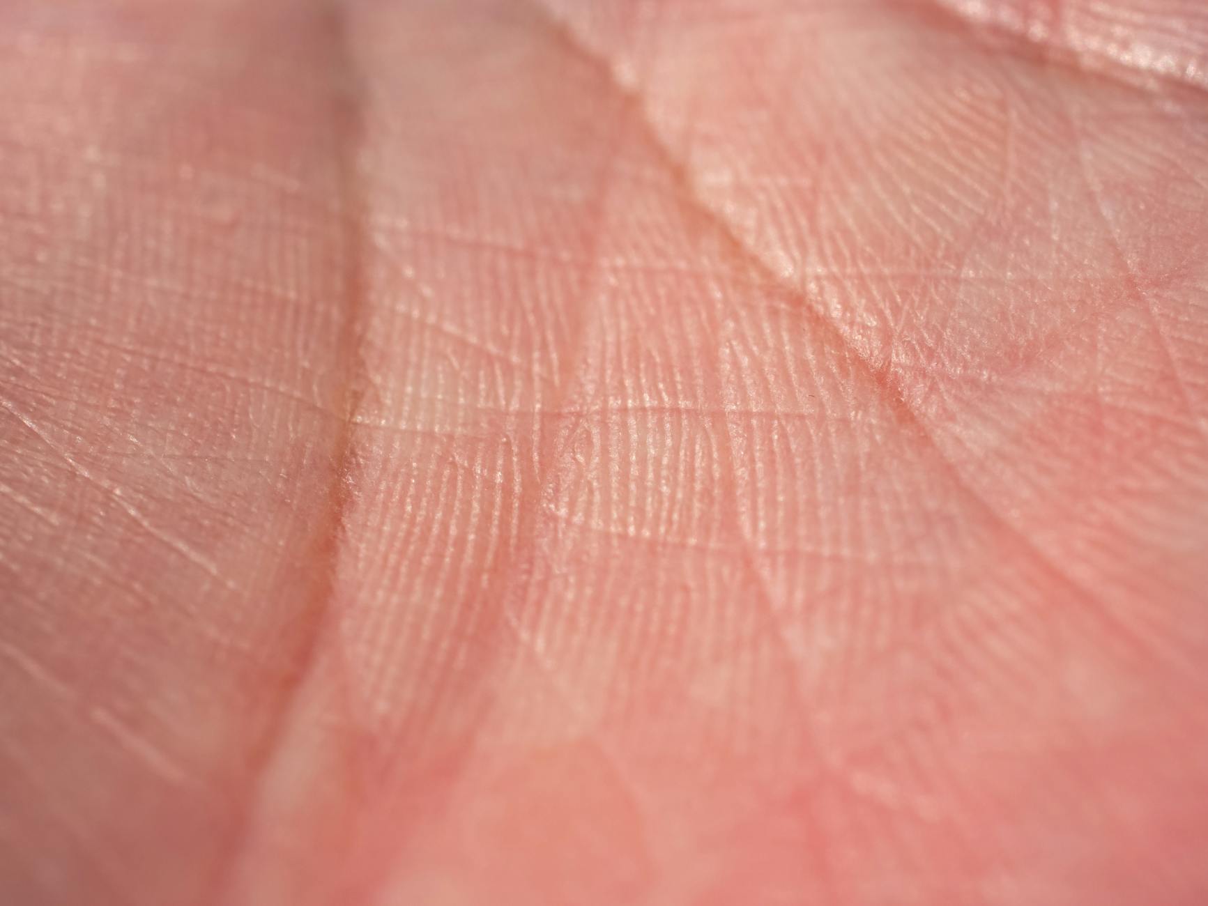 Why Is Pore Size Genetically Fixed and Cannot Be Permanently Reduced?