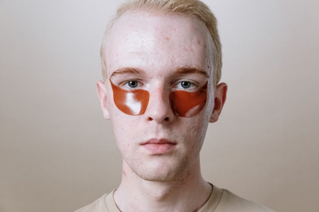 Acne Mark Treatment: Alite's New Science-Based Solution for Scar Removal - Featured image