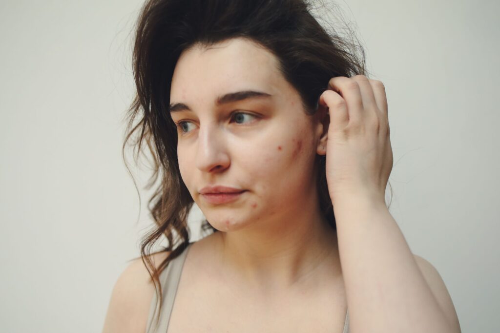 Body Acne in Hot Weather: Best Washes for Chest Back and Shoulders - Featured image