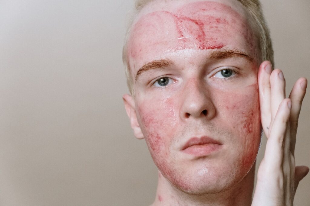 Accutane access broadening: new dermatologist protocols reshape cystic acne treatment eligibility - Featured image