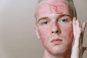 Accutane access broadening: new dermatologist protocols reshape cystic acne treatment eligibility - Featured image