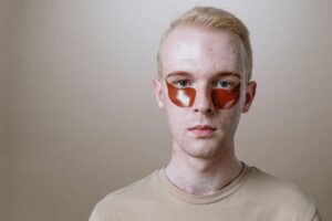 Acne Scar Removal: Key Facts, Safety Considerations, and Next Steps - Featured image