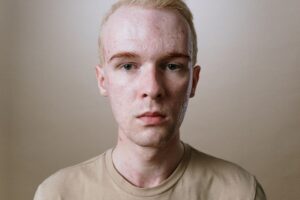 Chest Acne August 2026 Update: What Changed, Why It Matters, and What to Watch Next - Featured image