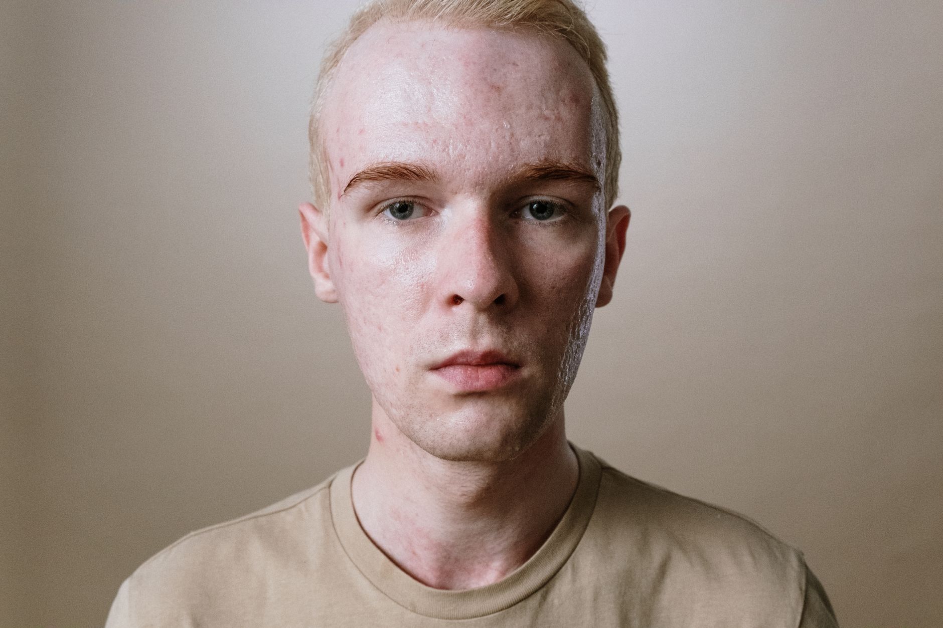 Chest Acne August 2026 Update: What Changed, Why It Matters, and What to Watch Next - Featured image