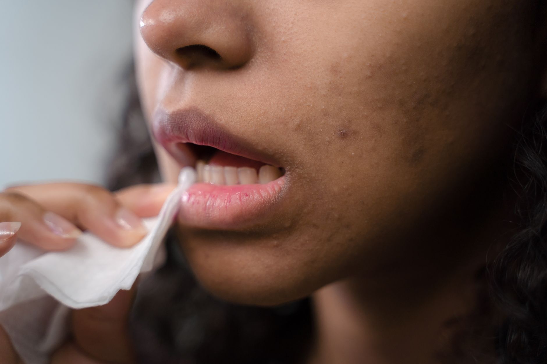 Diet and Acne August 2026 Update: What Changed, Why It Matters, and What to Watch Next - Featured image