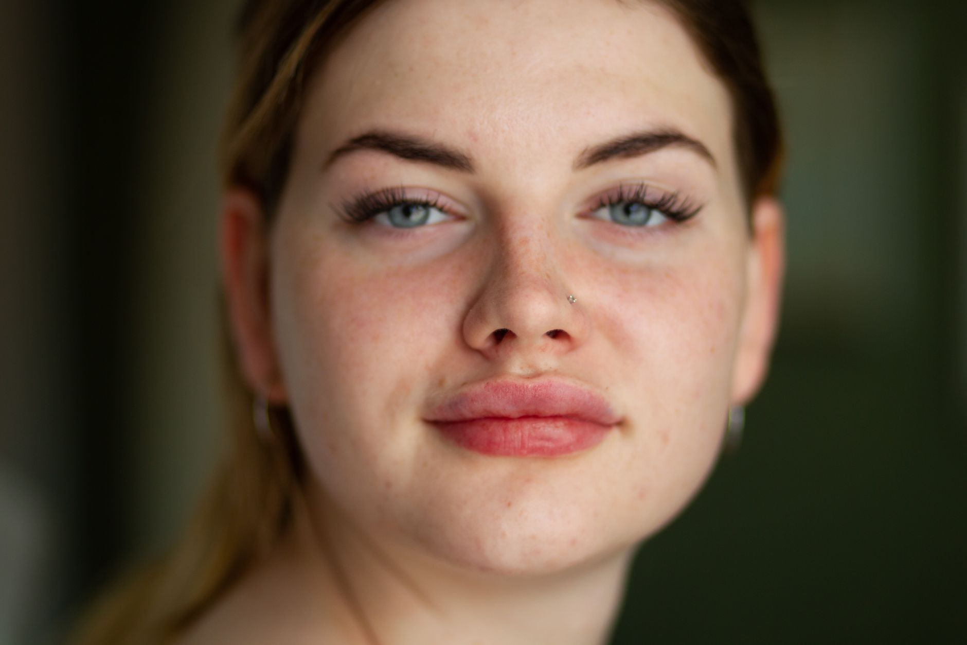 Cumulative Isotretinoin Dose and Acne Relapse in a 2026 Trial: A Source-Checked 2026 Briefing for Adults With Persistent Acne - Featured image