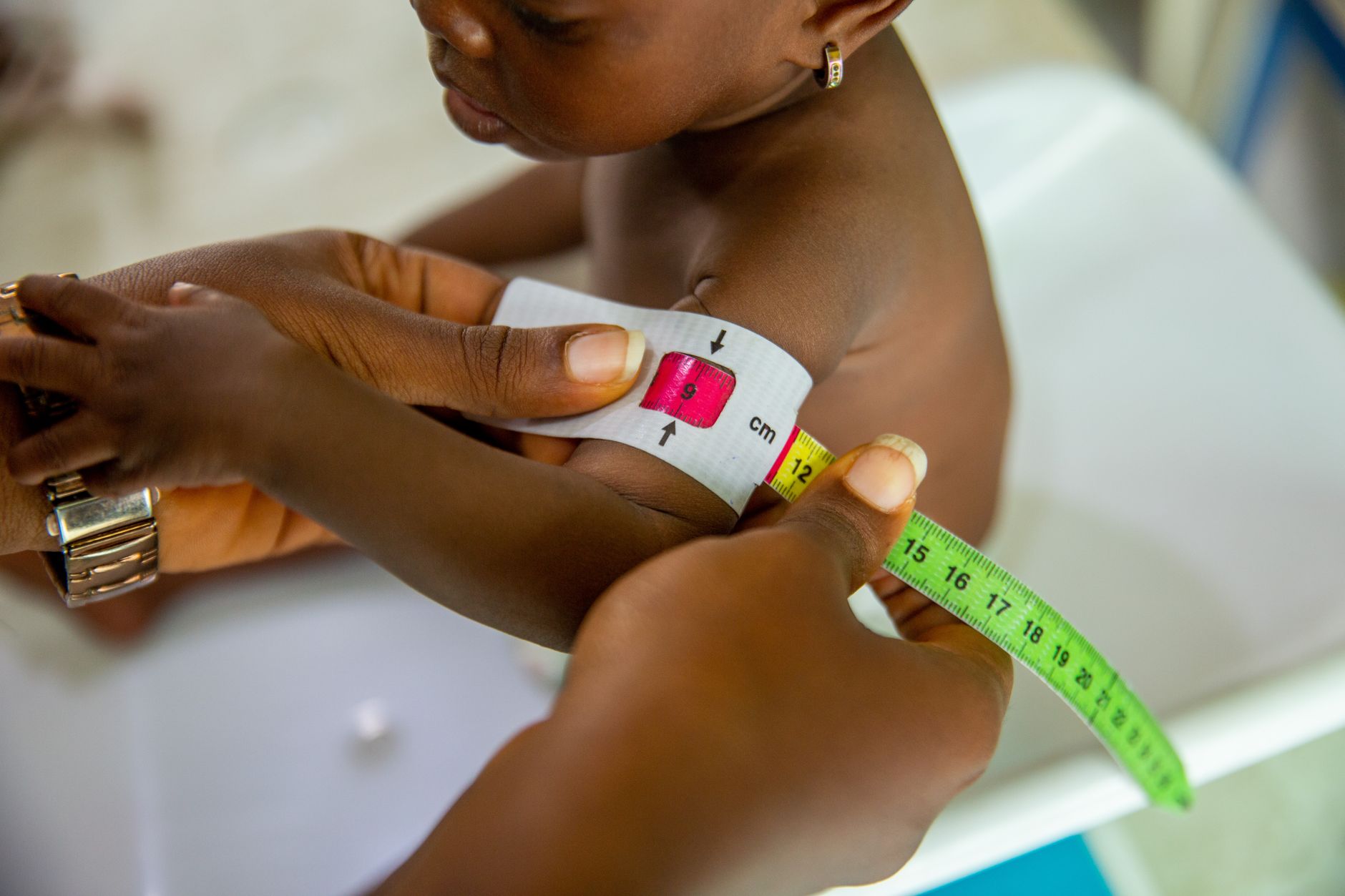 Early Pediatric Acne Assessment Highlighted at AAD 2026: Treatment-Selection Questions for Parents of Children With Acne - Featured image