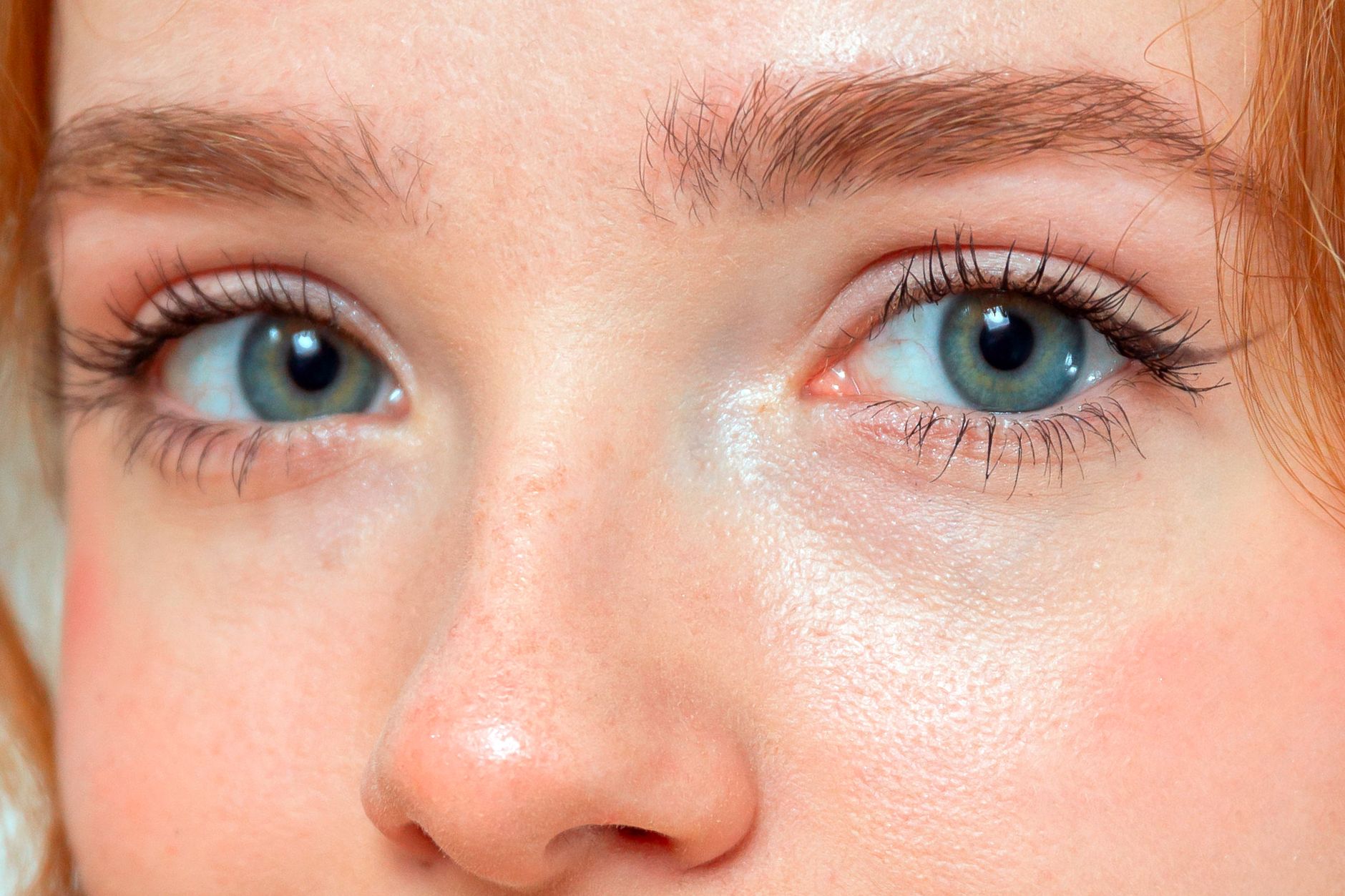 Iris Apatow's Hormonal Acne Story - Featured image