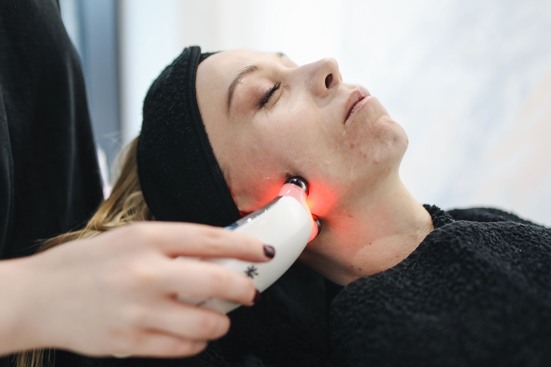 Microneedling Acne Scars Decision Guide - Featured image