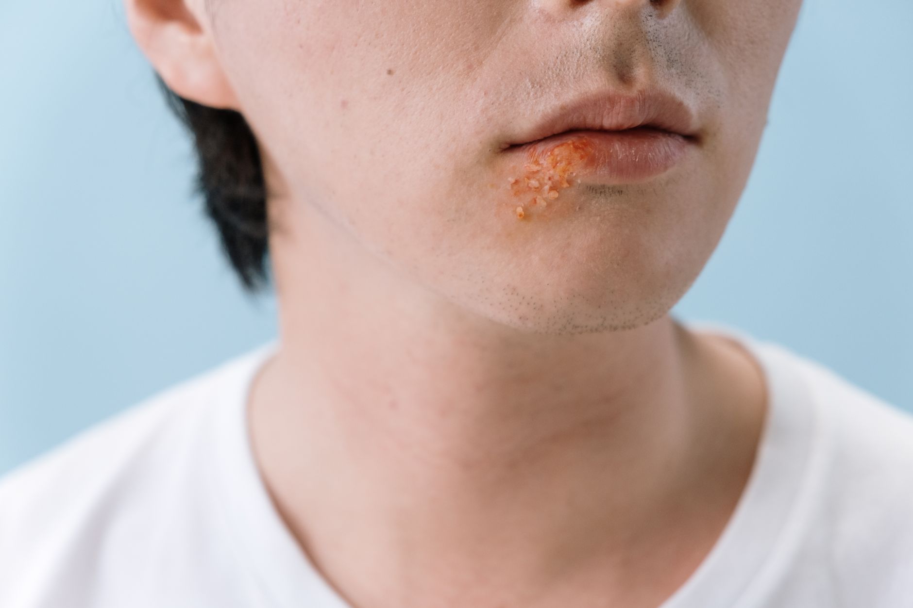 Oral Doxycycline for Acne in a 2026 Systematic Review: Study Design and Evidence Limits for Adults With Persistent Acne - Featured image