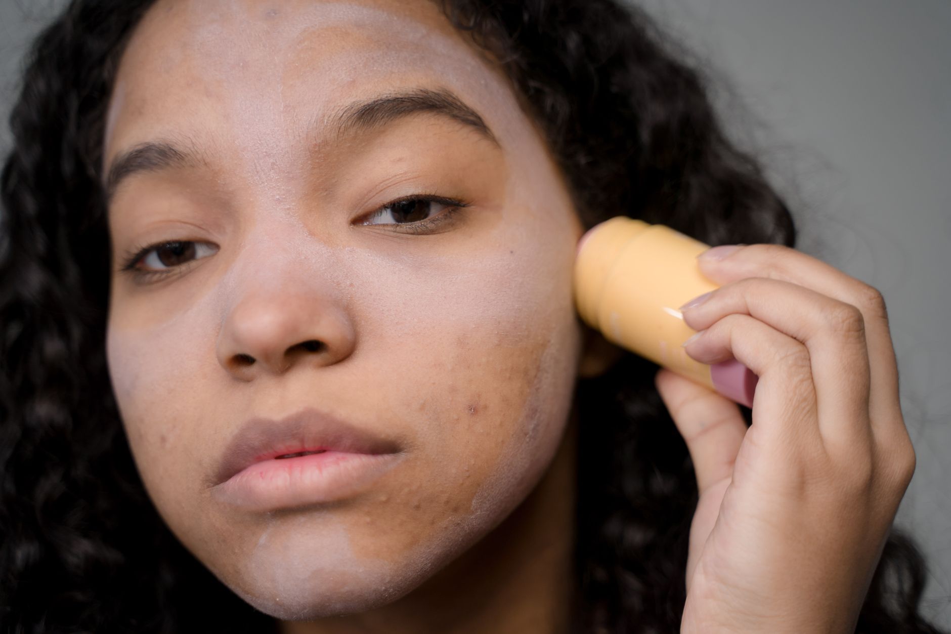 Pediatric Acne and Rosacea at the 2026 AAD Annual Meeting: How Parents of Teens With Acne Can Read the Conference Headline Carefully - Featured image