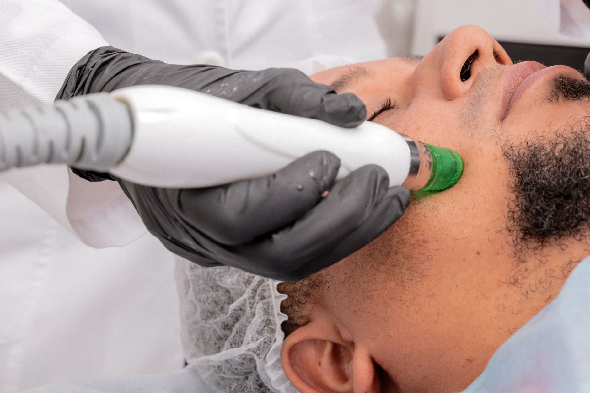 Radiofrequency Microneedling vs Fractional CO2 for Acne Scars in 2026: Questions People With Atrophic Acne Scars Can Ask Before a Procedure - Featured image