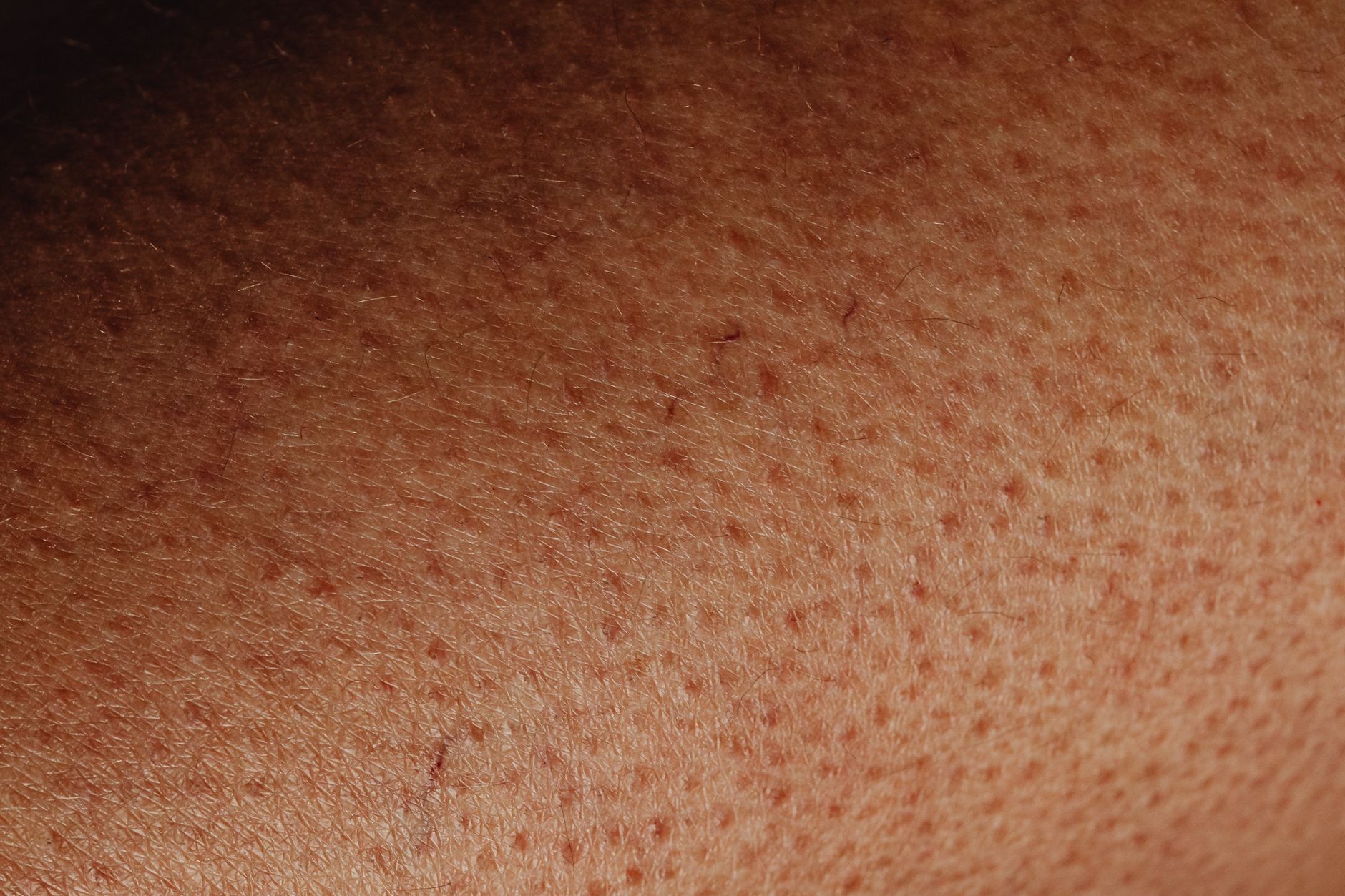 Recovery and Pigment Safety in the 2026 Split-Face Acne Scar Trial: What Longer Follow-Up Must Show for People With Atrophic Acne Scars - Featured image