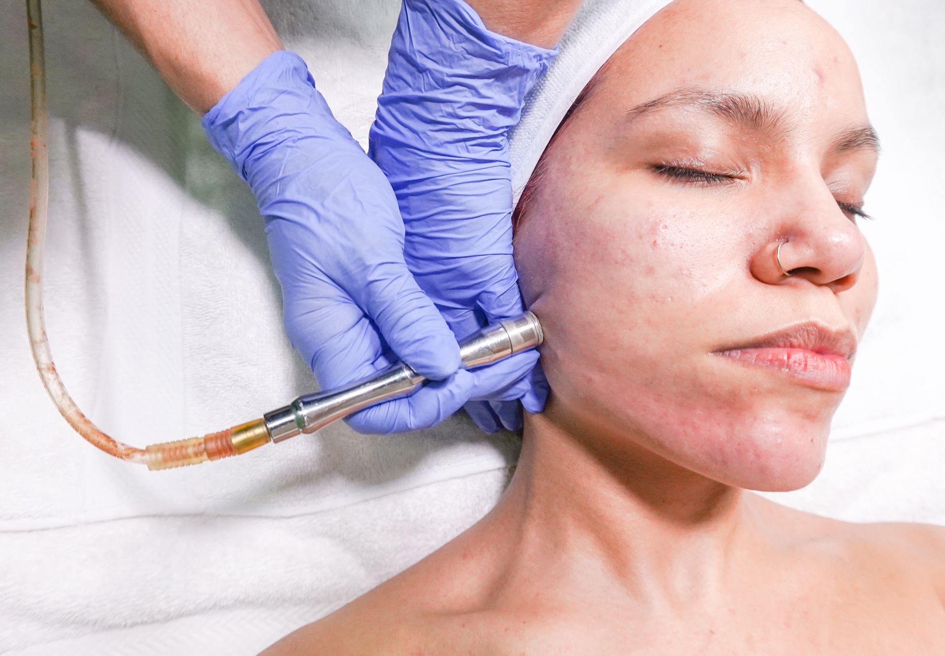 RF Microneedling for Acne Scars: How to Check a Clinic's Device and Safety Claims - Featured image