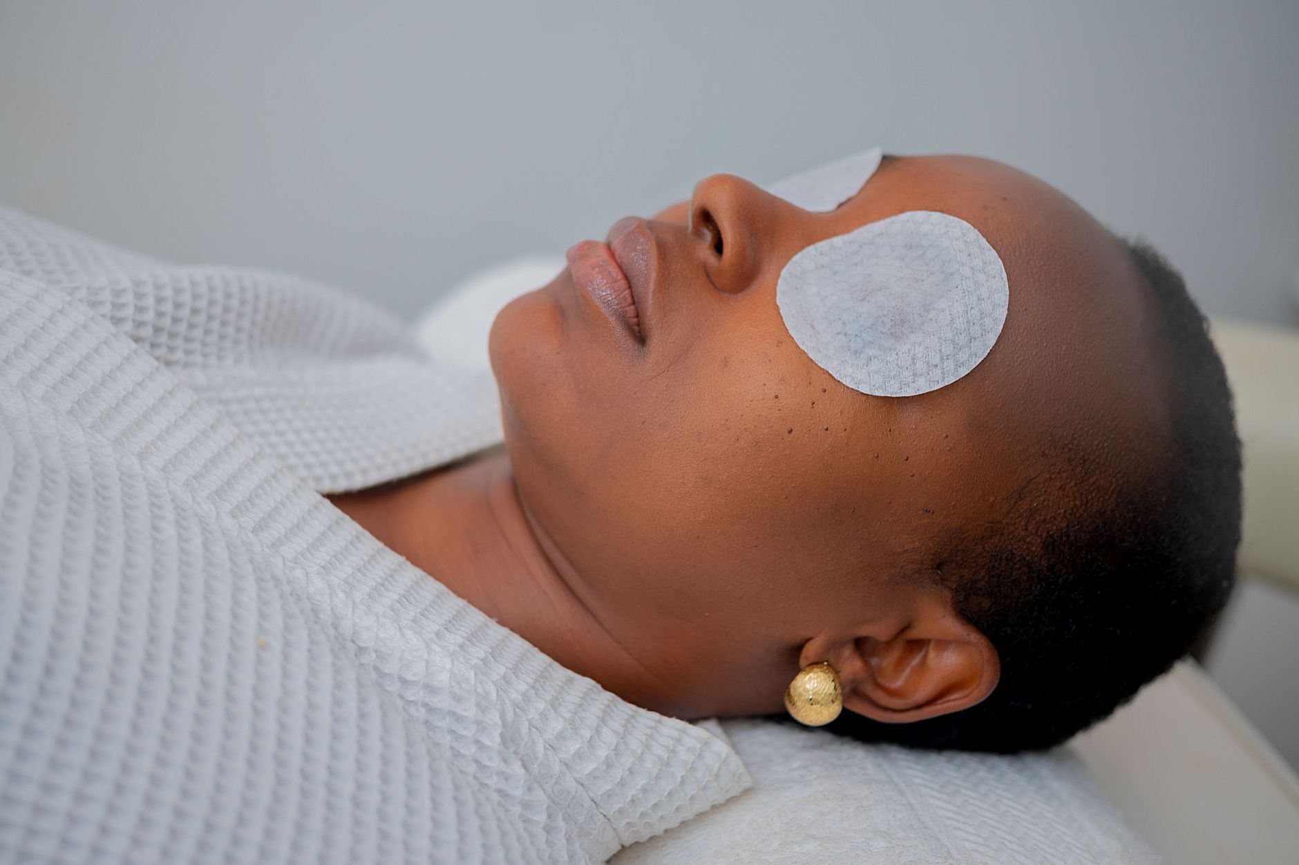 The 160-Participant Acne Scar Combination Trial Published in 2026: What Longer Follow-Up Must Show for People With Atrophic Acne Scars - Featured image