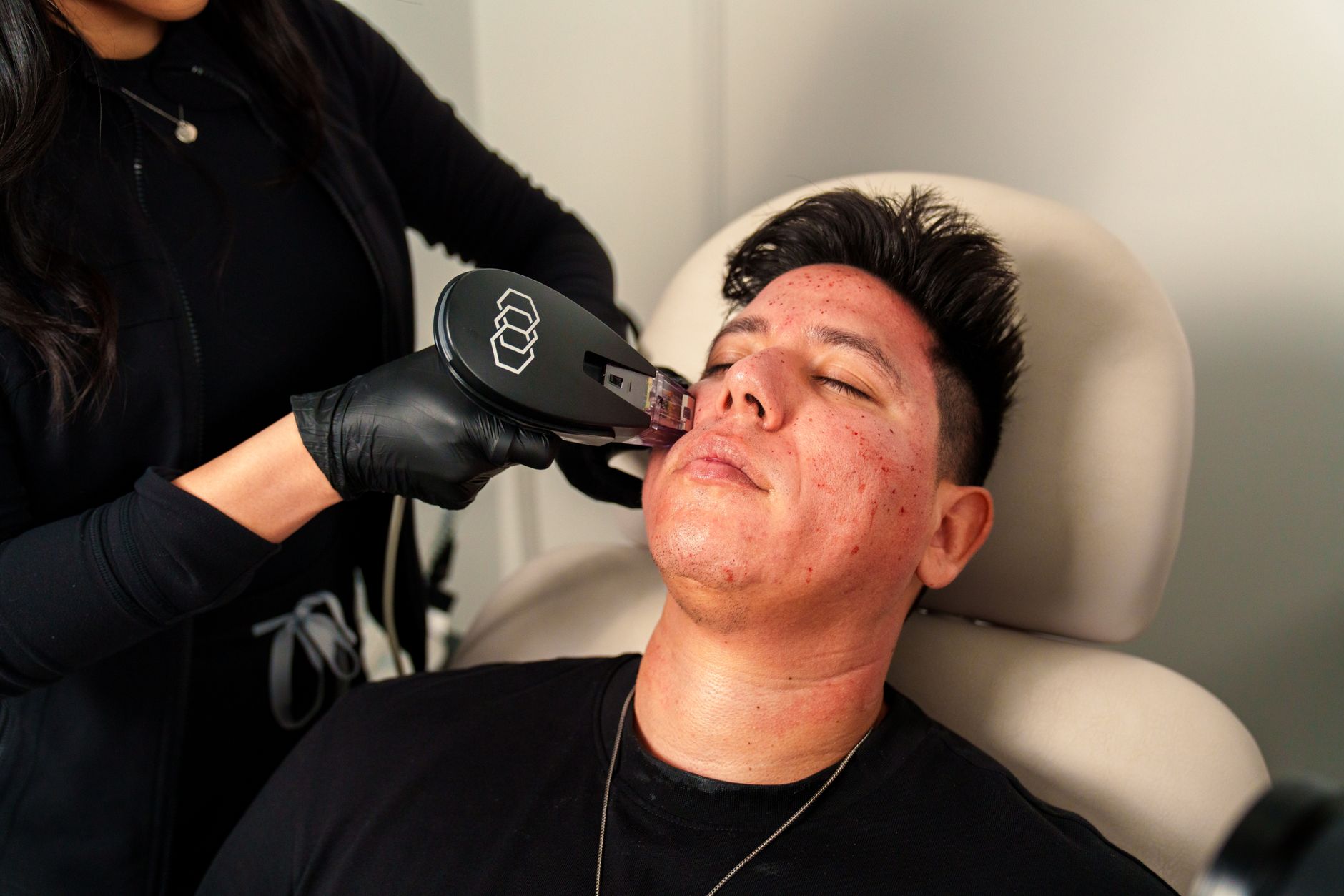 Understanding Morpheus8 Acne Scars: Evidence, Limits, and Next Steps - Featured image