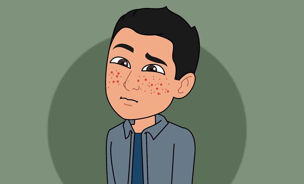 Why the 2026 Acne Body Image Study Does Not Prove Causation: Whole-Person Acne Care Considerations for Teens With Acne - Featured image