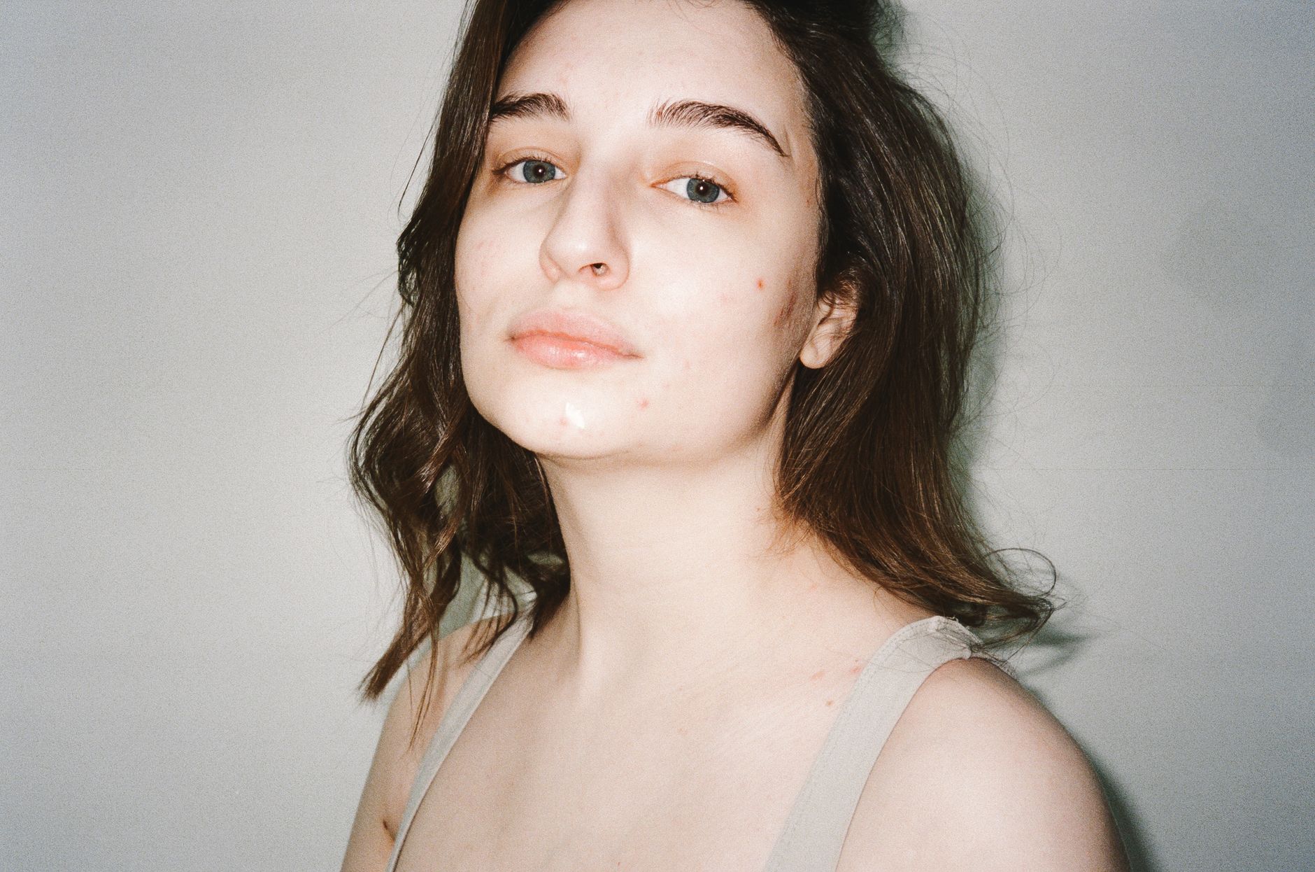 Why the 2026 Acne Body Image Study Does Not Prove Causation: What the Findings Mean for Teens With Acne - Featured image